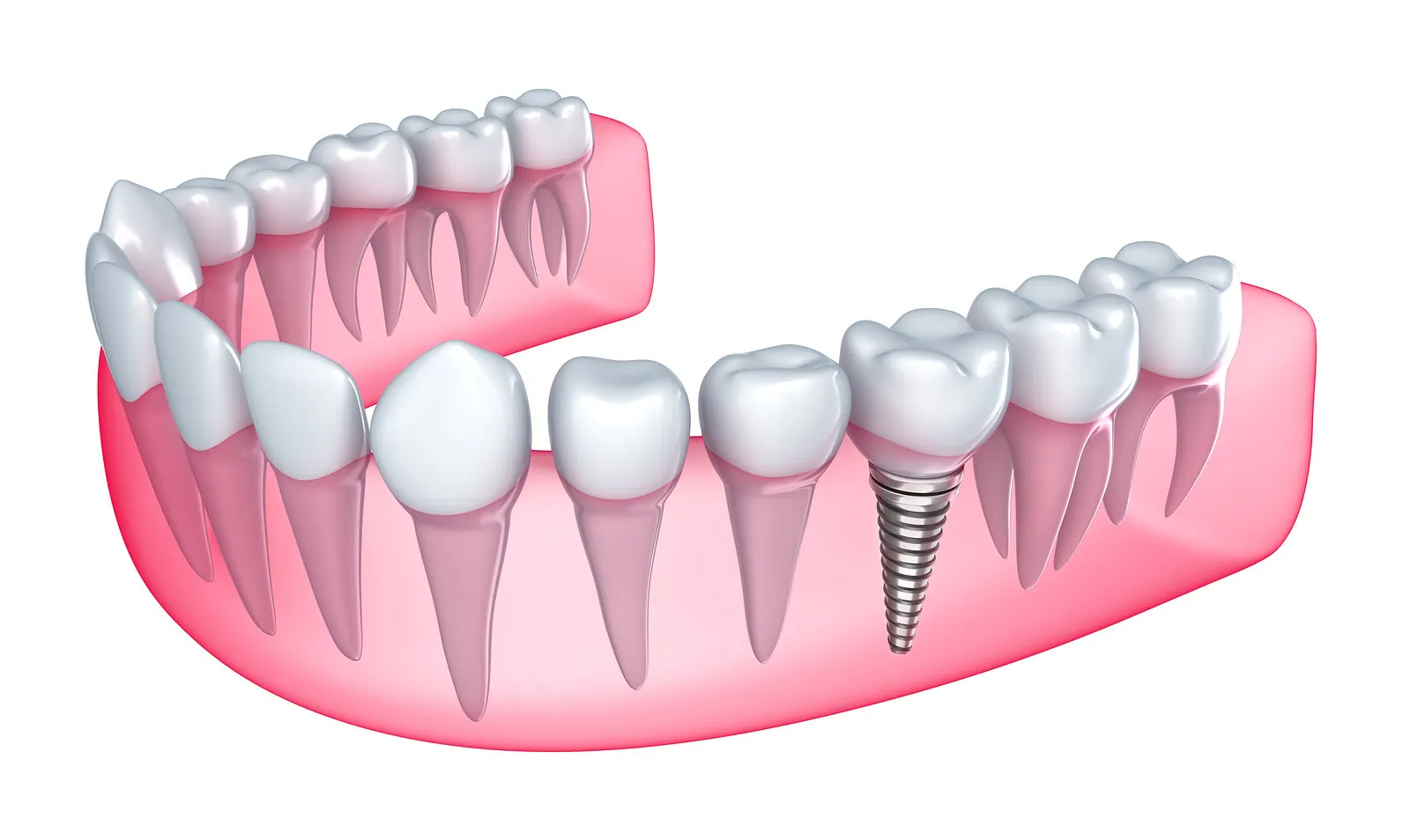 Illustration of a dental implant replacing a missing lower tooth
